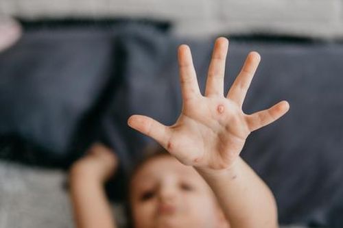 Mắc thủy đậu, sau bao lâu trẻ có thể đi học trở lại?