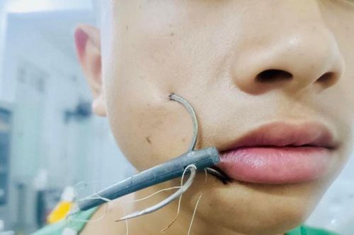 Tai nạn khi câu cá, bé trai nhập viện vì lưỡi câu móc vào mặt