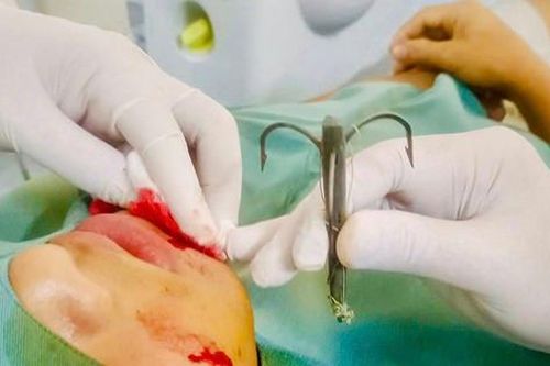 Đi câu cá, lưỡi câu móc vào má