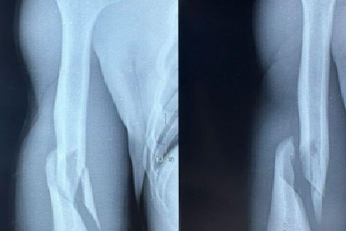 Thanh niên 19 tuổi gãy xương cánh tay vì vật tay