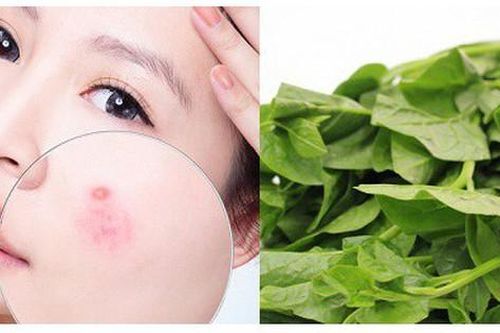 Cách dùng rau mồng tơi chữa lành da mụn trứng cá