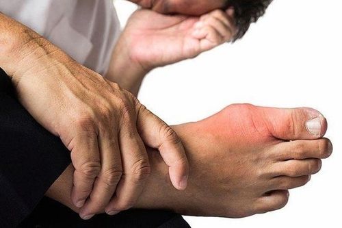 Đối mặt nguy cơ tàn phế sau khi chữa gout bằng phương pháp truyền miệng