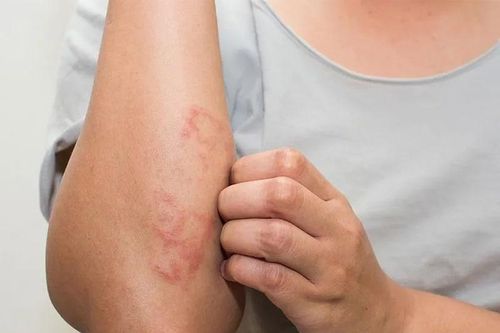 Không đốt, không cắn nhưng vẫn khiến da phồng rộp: Kiến ba khoang nguy hiểm theo cách ít ai ngờ