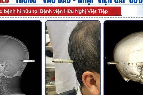 Người đàn ông bị phi tiêu cắm trúng đầu nhập viện khẩn cấp
