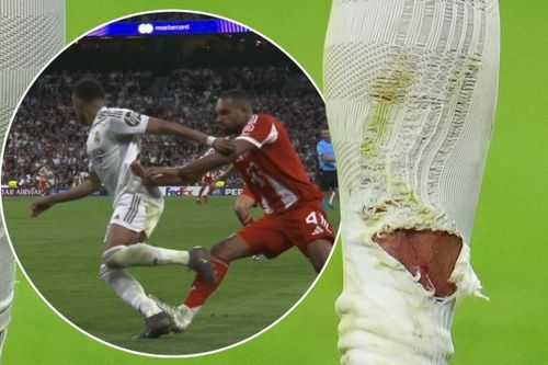 Vết thương gây lo lắng của Mbappe