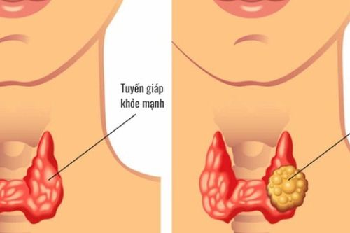 Chủ quan với nhân tuyến giáp, người phụ nữ trẻ đi khám phát hiện 13 hạch di căn