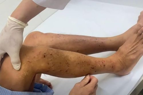 Người đàn ông nhiễm cùng lúc sán dây chó và giun đũa