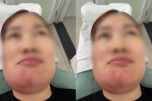 Người phụ nữ nhập viện sau 7 ngày tự nặn mụn tại nhà