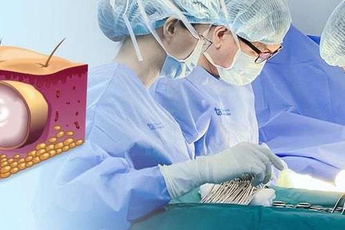 U bã đậu 10 năm bất ngờ hóa ung thư ở người đàn ông 40 tuổi, dấu hiệu cảnh báo nhiều người bỏ qua