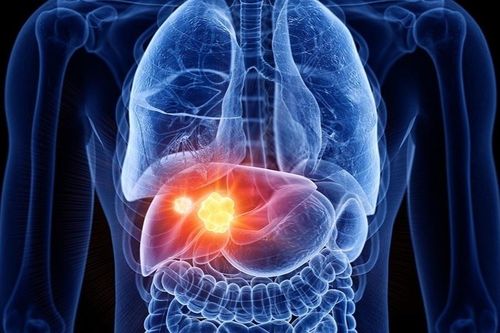 Mắc ung thư gan vì thói quen nhiều người tưởng vô hại