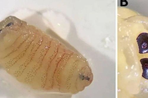 Người phụ nữ kinh hãi phát hiện sinh vật lạ đang 'ăn' dần vách ngăn mặt sau 2 tuần đau đớn