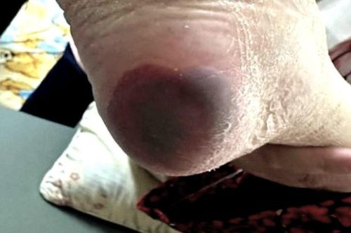 Lâm bạo bệnh vì sai lầm tai hại sau khi bị mảnh sành đâm