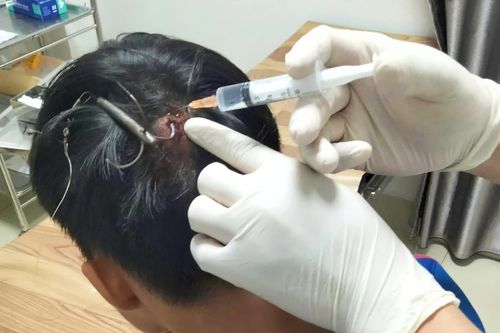 Tai nạn hy hữu: Móc câu 3 tiêu cắm vào đỉnh đầu thiếu niên