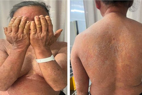 Đừng biến bệnh nấm da thành 'thảm họa' vì thuốc bôi không rõ loại