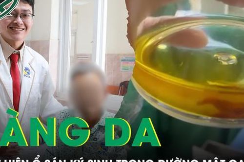 Vàng da, tắc mật do sán ký sinh trong đường mật gan