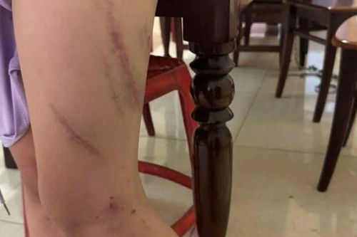 Bé gái 9 tuổi chi chít vết bầm trên cơ thể, nghi bị mẹ bạo hành