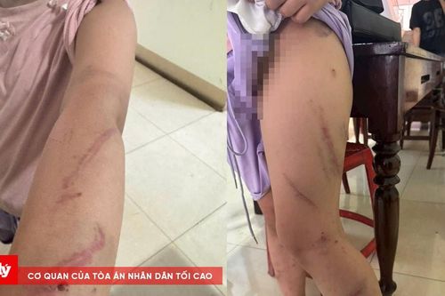 Bé gái 9 tuổi nghi bị bạo hành, cơ thể có 34 vết bầm