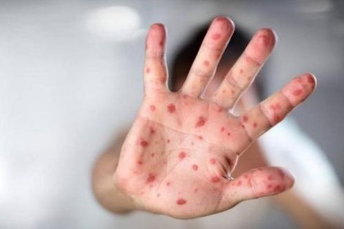 Chưa hết tay chân miệng lại nỗi lo sốt xuất huyết, ứng phó ra sao?