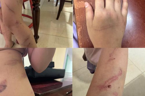 Xác minh vụ bé gái 9 tuổi có 34 vết bầm nghi bị bạo hành ở Đắk Lắk