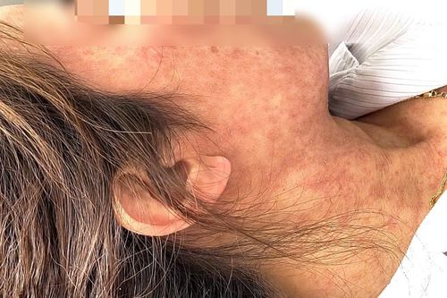 Lây bệnh từ cháu, người phụ nữ nhập viện với hàng loạt biến chứng