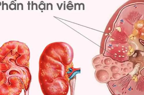 Bé gái 11 tuổi co giật, tăng huyết áp sau viêm họng do biến chứng viêm cầu thận hậu nhiễm liên cầu