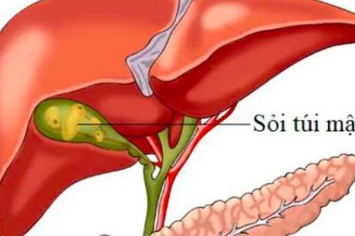 Dấu hiệu cảnh báo sỏi túi mật, nhận biết sớm để tránh biến chứng nguy hiểm