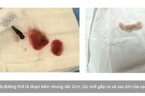 Kịp thời cứu trẻ 3 tuổi nuốt đoạn kẽm nhung dài 2cm
