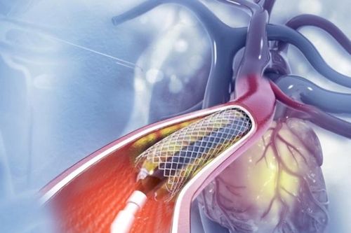 Đặt xong stent mạch vành là khỏi bệnh?