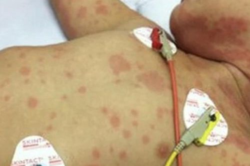 TP.HCM ghi nhận ca tử vong do não mô cầu, cảnh báo bệnh diễn tiến cực nhanh