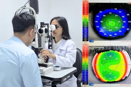 Phát hiện nhiều trường hợp giác mạc chóp ở người trẻ từ những bệnh nhân đo cắt kính thông thường
