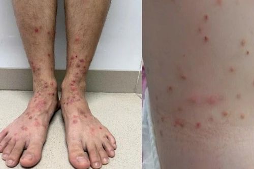 Gia tăng ca bệnh sẩn ngứa do bọ chét, nhiều người tự điều trị sai cách