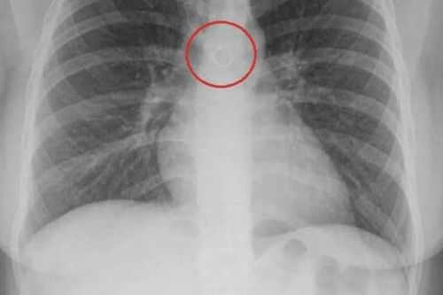 Ho suốt một tháng, cô gái sốc nặng phát hiện khuyên mũi 'lạc' vào phổi