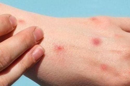 Nuôi thú cưng, cảnh giác sẩn ngứa do bọ chét