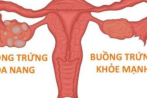 Phụ nữ mắc hội chứng buồng trứng đa nang có mang thai được không?
