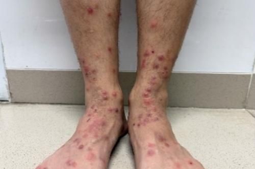 Liên tiếp người nhập viện với chi chít vết đỏ, cùng một nguyên do