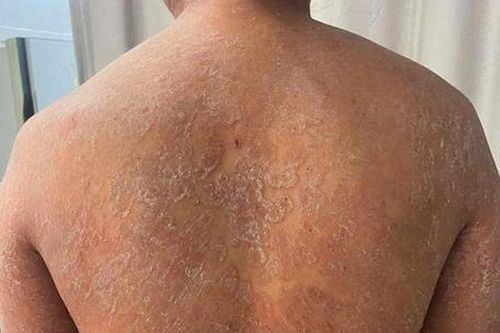 Suýt mất làn da khi tự chữa nấm bằng kem bôi không rõ nguồn gốc