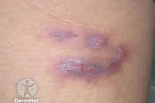 Thái Lan ban hành cảnh báo khẩn cấp về bệnh 'sốt đất'