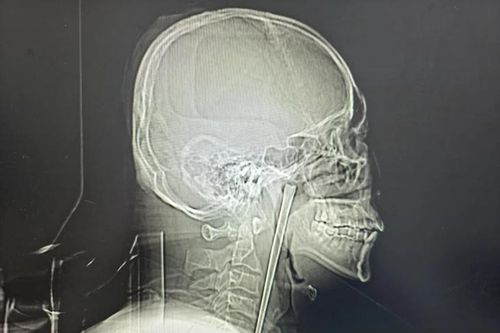 Người đàn ông sống tám năm với đũa kim loại dài 12cm mắc trong cổ họng