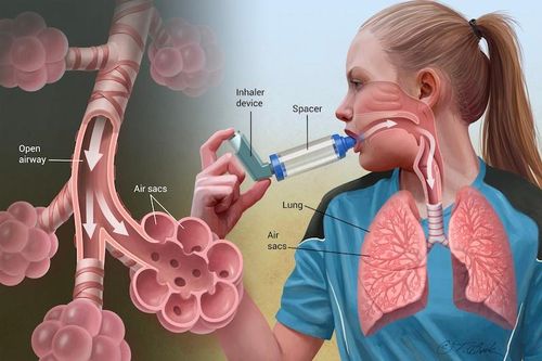 Triệu chứng thường gặp và các mức độ khó thở ở hen suyễn