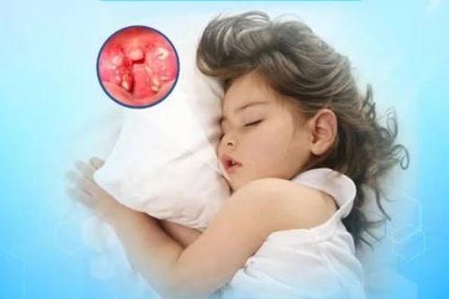 Trẻ ngưng thở khi ngủ ngáy, cha mẹ không nên chủ quan