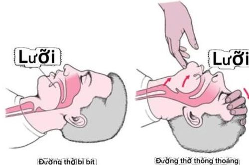 Cấp cứu 'nuốt lưỡi'