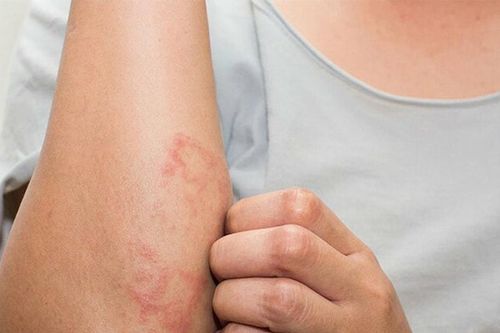 Viêm mao mạch dị ứng: Không quá đáng sợ nhưng cần nhận biết đúng bệnh