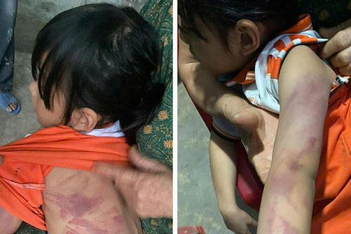Hà Tĩnh: Nhà trường xin lỗi sau vụ học sinh lớp 2 bị bạn cùng lớp đánh bầm tím