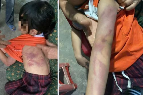 Bé gái lớp 2 bị bạn dùng thước đánh bầm tím người trong giờ ra chơi
