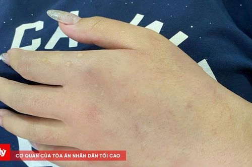 8 người nhập viện vì bị ong rừng đốt khi đi tảo mộ