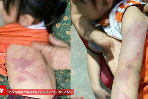 Học sinh lớp 2 bị bạn đánh bầm tím trong giờ ra chơi