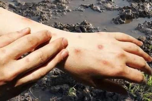 Bộ Y tế cảnh báo về bệnh 'sốt đất' khiến 732 ca nhiễm, 23 trường hợp tử vong tại Thái Lan