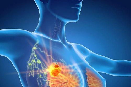 Phát hiện đột biến gen di truyền trên bệnh nhân ung thư vú