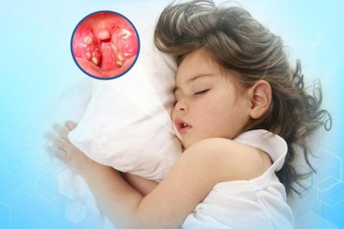 Ngưng thở khi ngủ do amidan quá phát ở trẻ nhỏ, phụ huynh không nên chủ quan