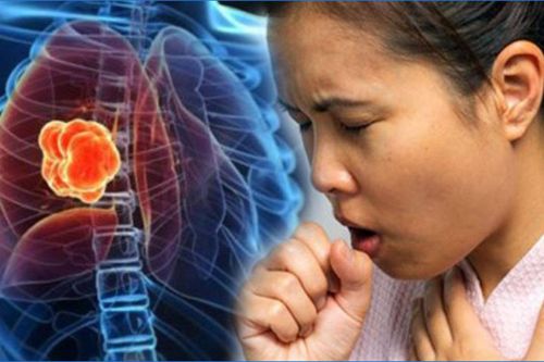 2 dấu hiệu khi ho cảnh báo ung thư phổi dễ bị bỏ qua